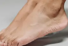 Coalizão tarsal talocalcaneana