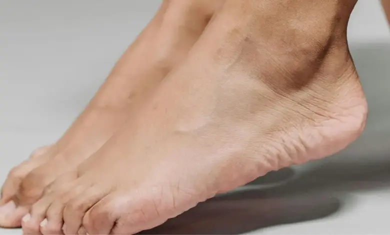 Coalizão tarsal talocalcaneana