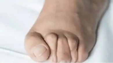 Como saber se tenho joanete