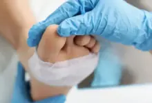 Dedo do pé roxo