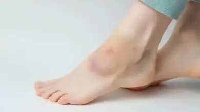 Derrame articular no tornozelo