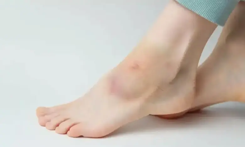 Derrame articular no tornozelo