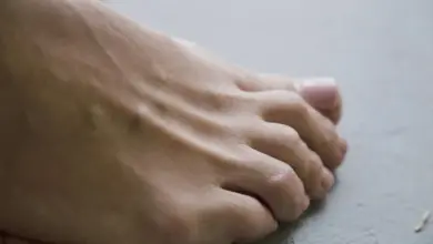 Joanete volta depois da cirurgia