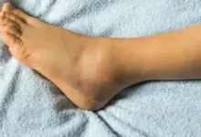 Lipedema no tornozelo