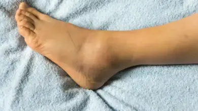 Lipedema no tornozelo