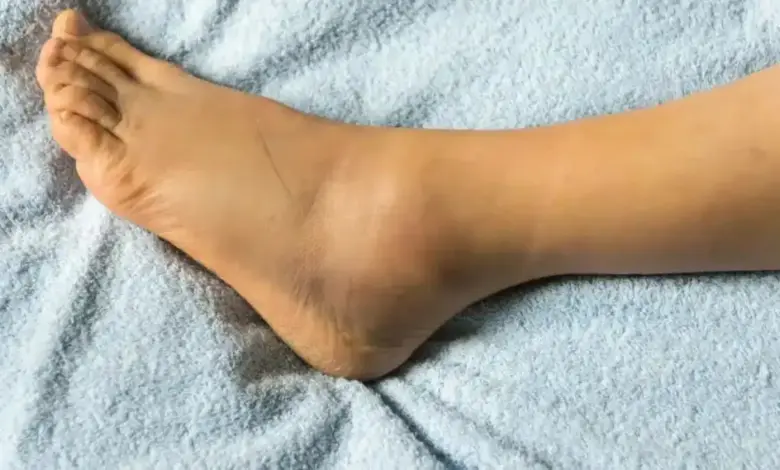Lipedema no tornozelo