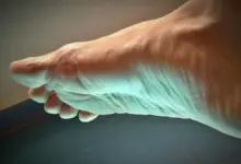 Pé inchado e roxo