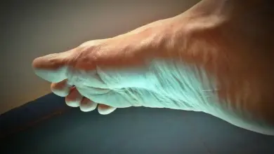 Pé inchado e roxo