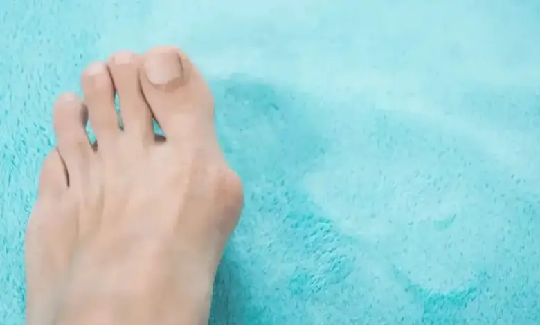 Tipos de joanete no pé