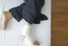 Quantos dias é a recuperação de cirurgia de joanete