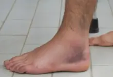 Distensão do tornozelo