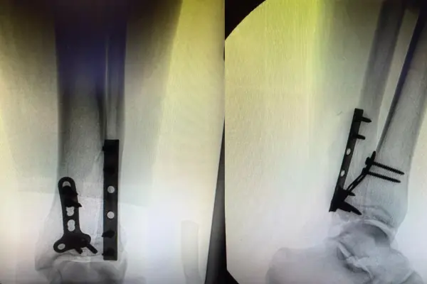 Cirurgia de Fratura de Tornozelo em Goiânia - Dr. Bruno Air