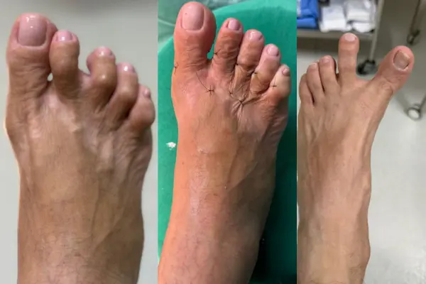 Cirurgia no Pé em Goiânia - Dr. Bruno Air