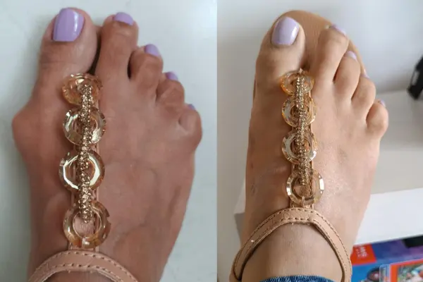 Cirurgia Percutânea de Joanetes em Goiânia - Dr. Bruno Air