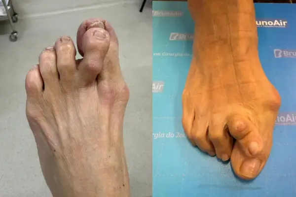 Tratamento Deformidade nos Dedos dos Pés em Goiânia - Dr. Bruno Air