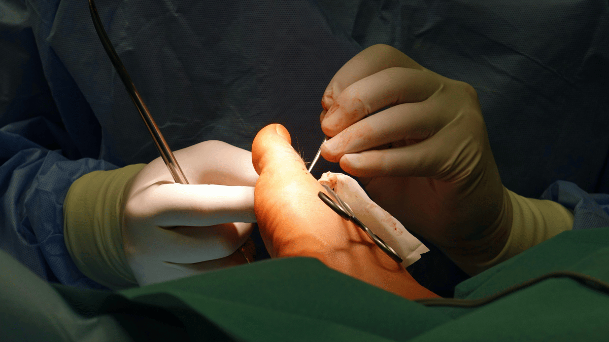 Como é feita a cirurgia de joanete