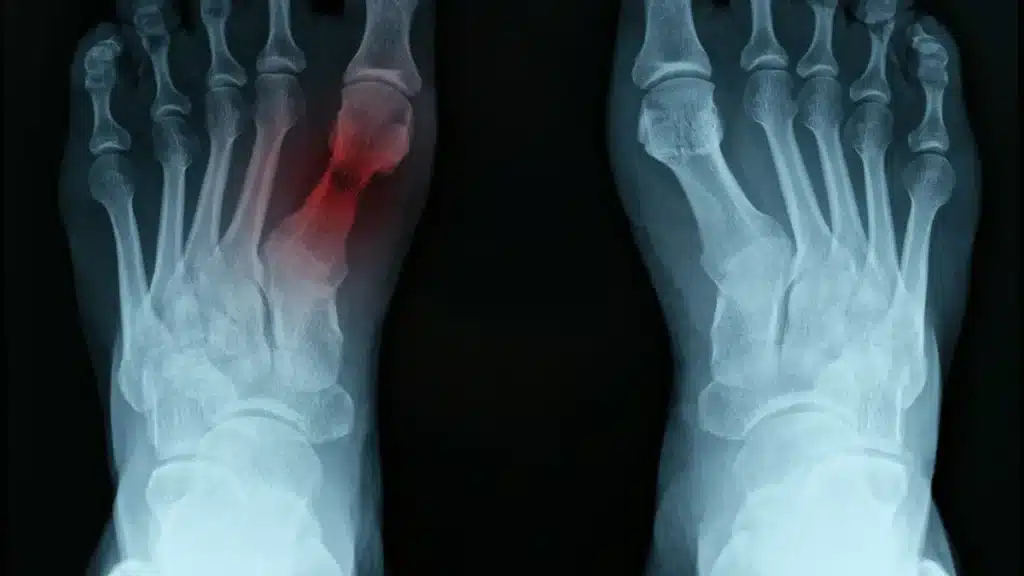 Coalizão tarsal