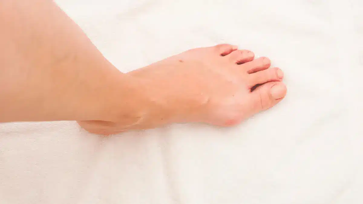 Cirurgia de Joanete com Bisturi: Guia Completo